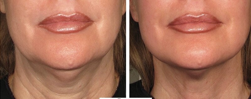 Neck fillers